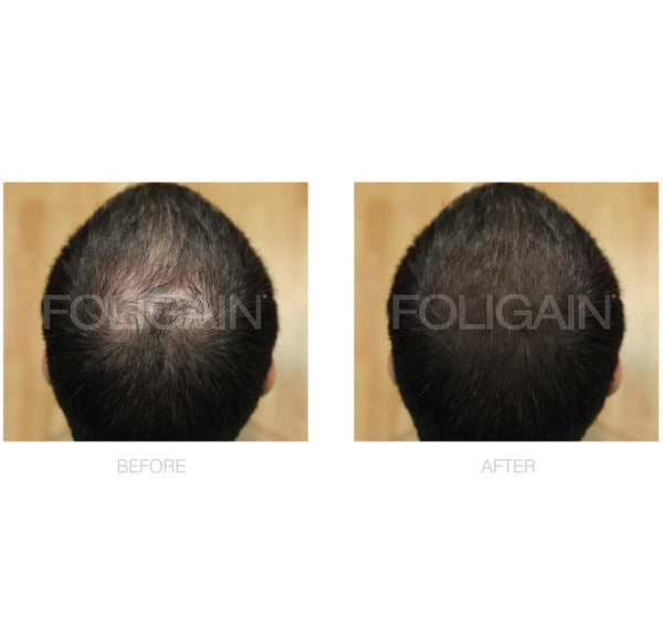 FOLIGAIN Minoxidil 5% Hair Regrowth Treatment For Men 6 Month Supply - FOLIGAIN EU